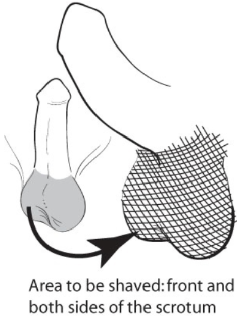 Preparing for Your Vasectomy - GippSnip